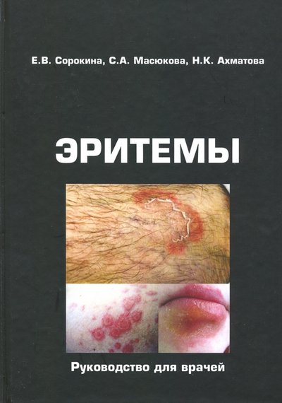 Книга: КнигИздат Эритемы. Руководство для врачей 978-5-9216-0177-2